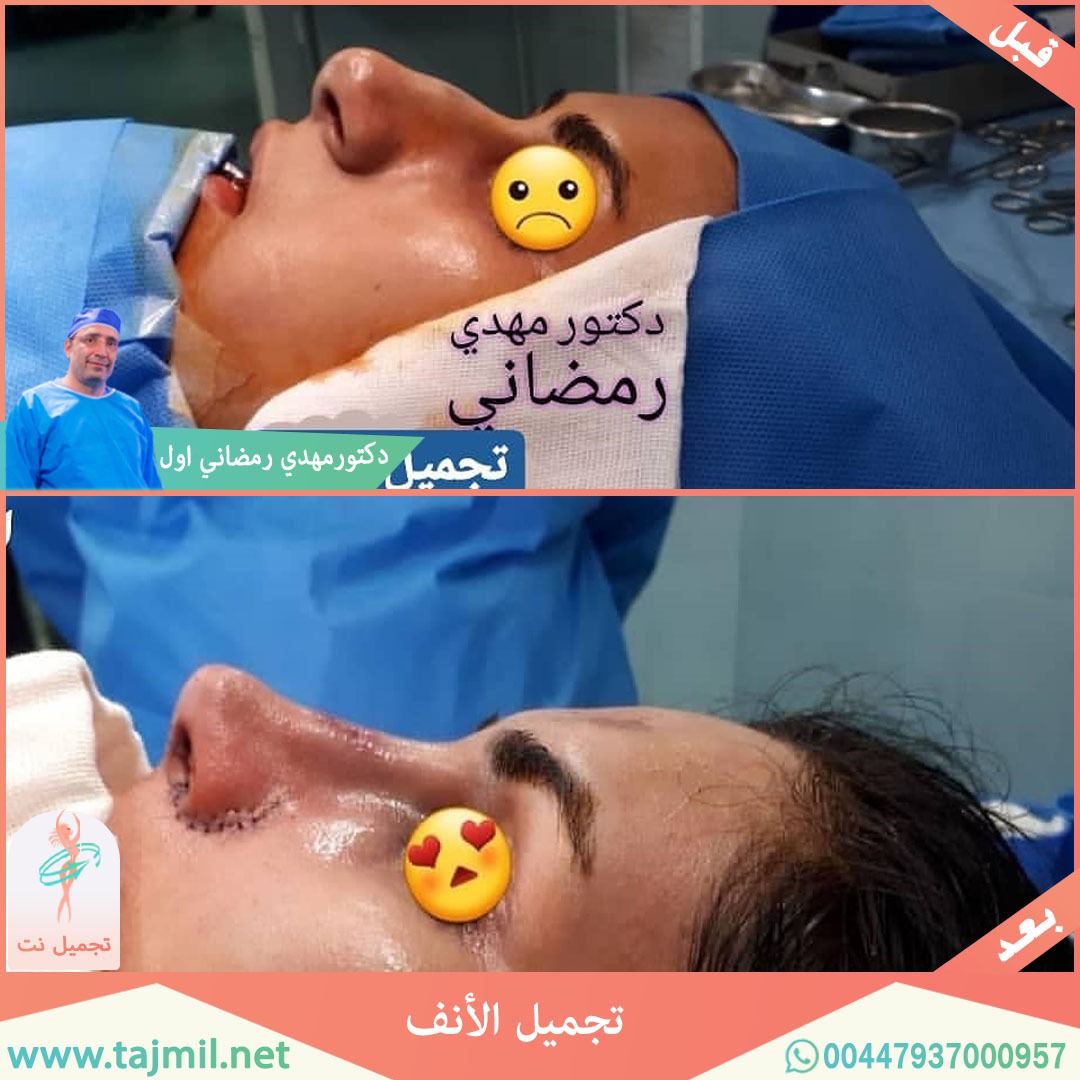  - دكتور مهدي رمضاني اول عملية تجميل الانف في ايران مع تجميل نت