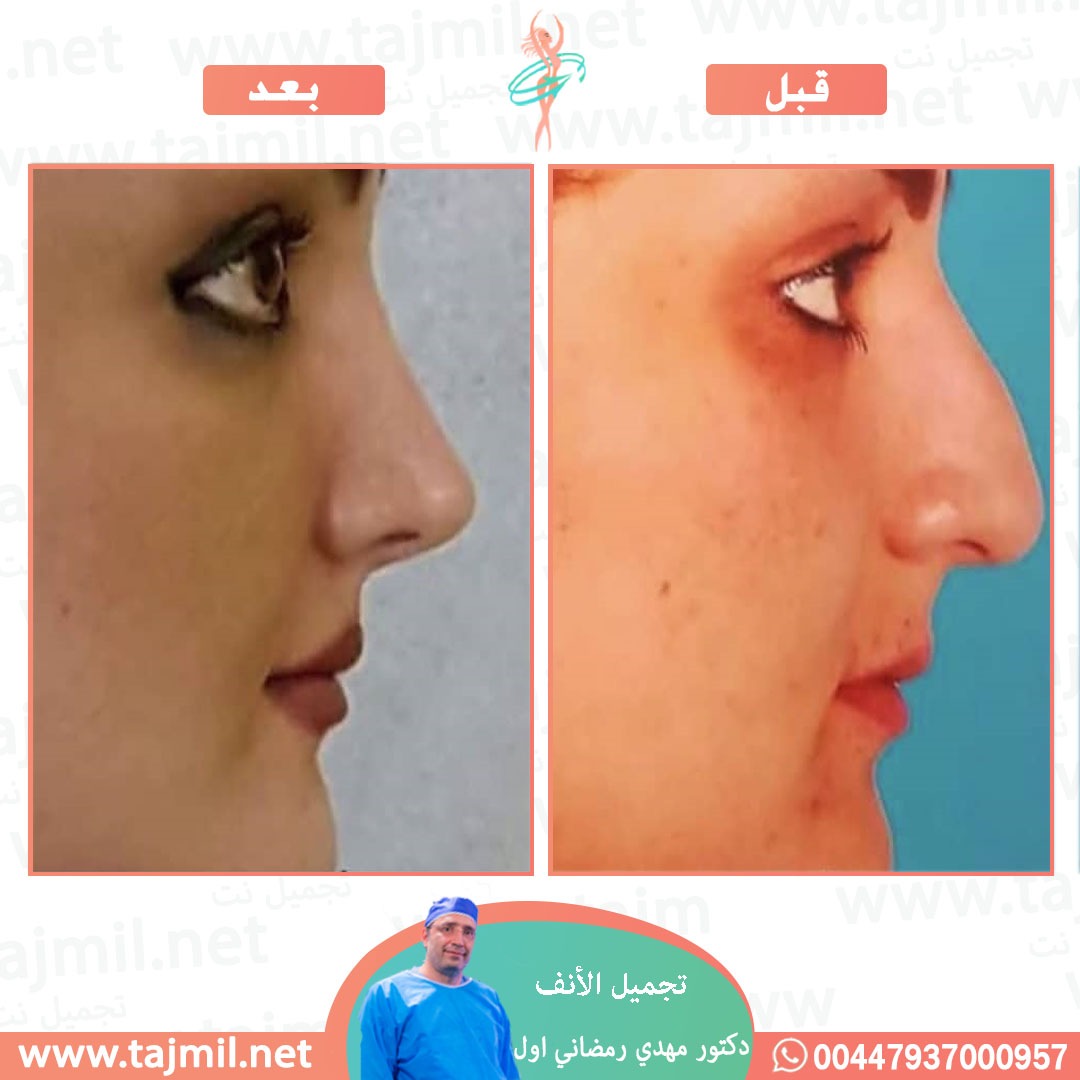  - دكتور مهدي رمضاني اول عملية تجميل الانف في ايران مع تجميل نت