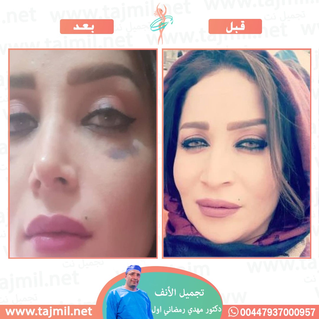  - دكتور مهدي رمضاني اول عملية تجميل الانف في ايران مع تجميل نت