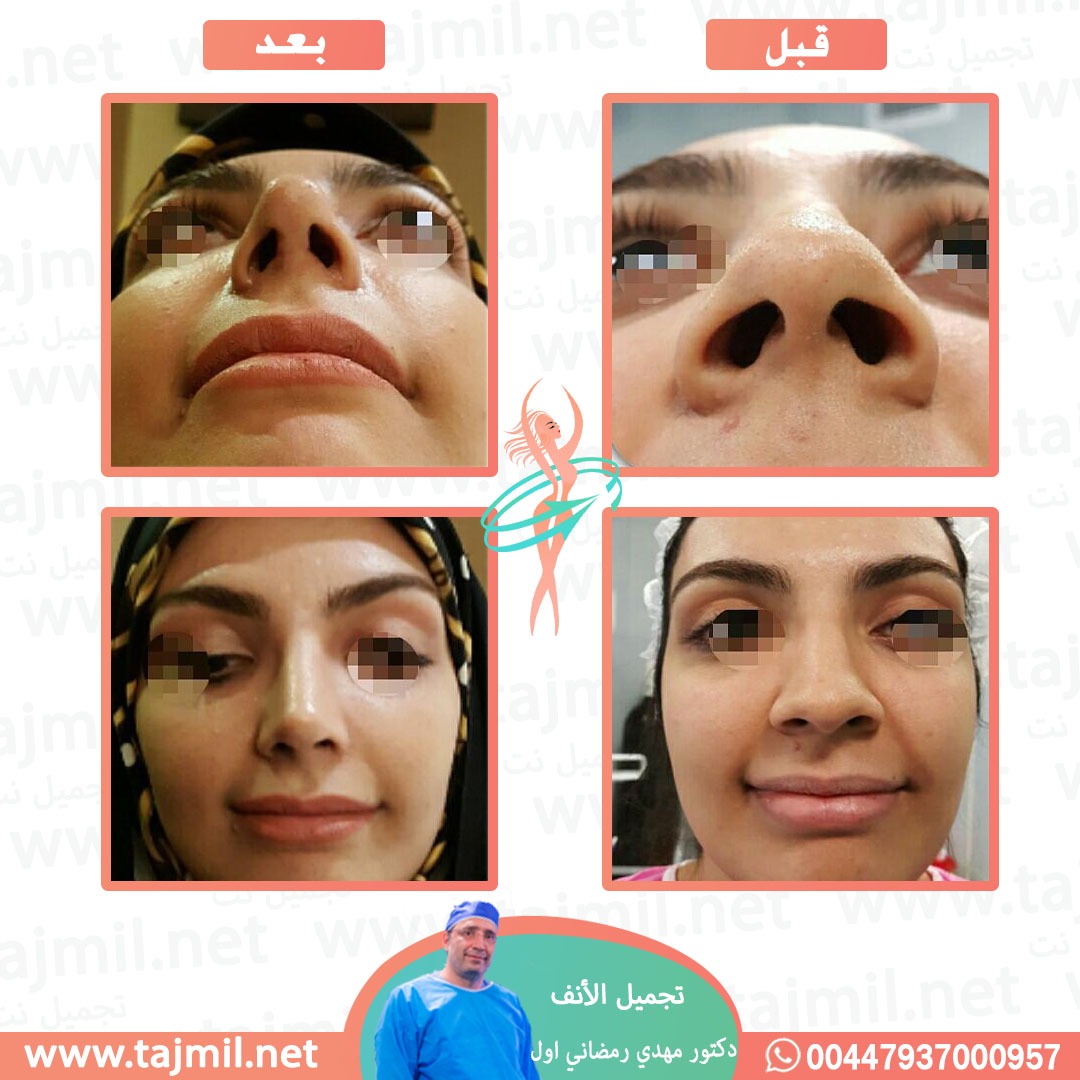  - دكتور مهدي رمضاني اول عملية تجميل الانف في ايران مع تجميل نت