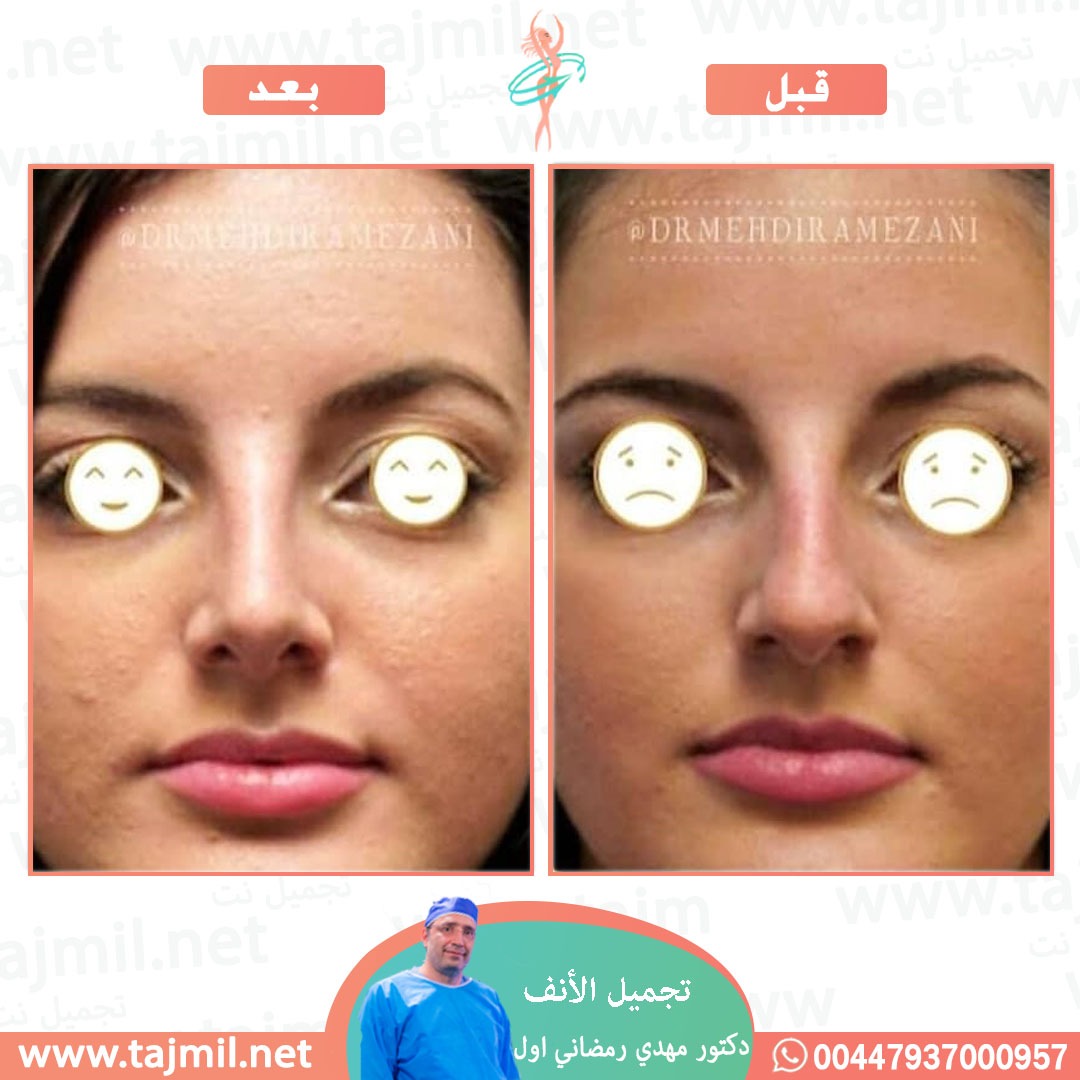  - دكتور مهدي رمضاني اول عملية تجميل الانف في ايران مع تجميل نت