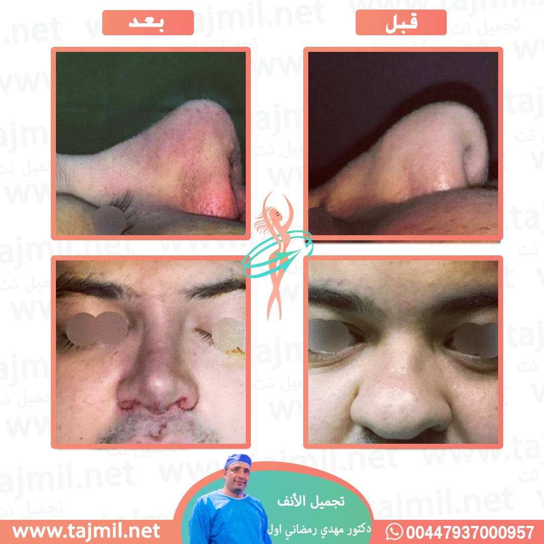  - دكتور مهدي رمضاني اول عملية تجميل الانف في ايران مع تجميل نت