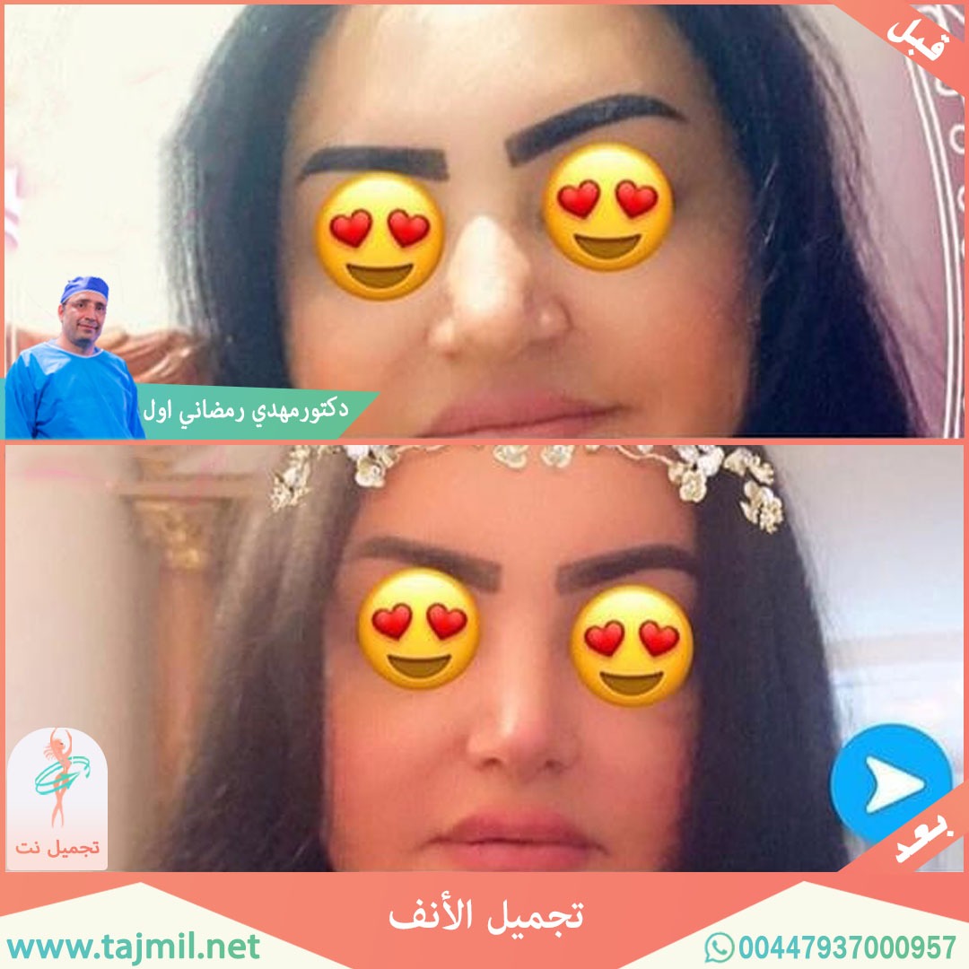  - دكتور مهدي رمضاني اول عملية تجميل الانف في ايران مع تجميل نت