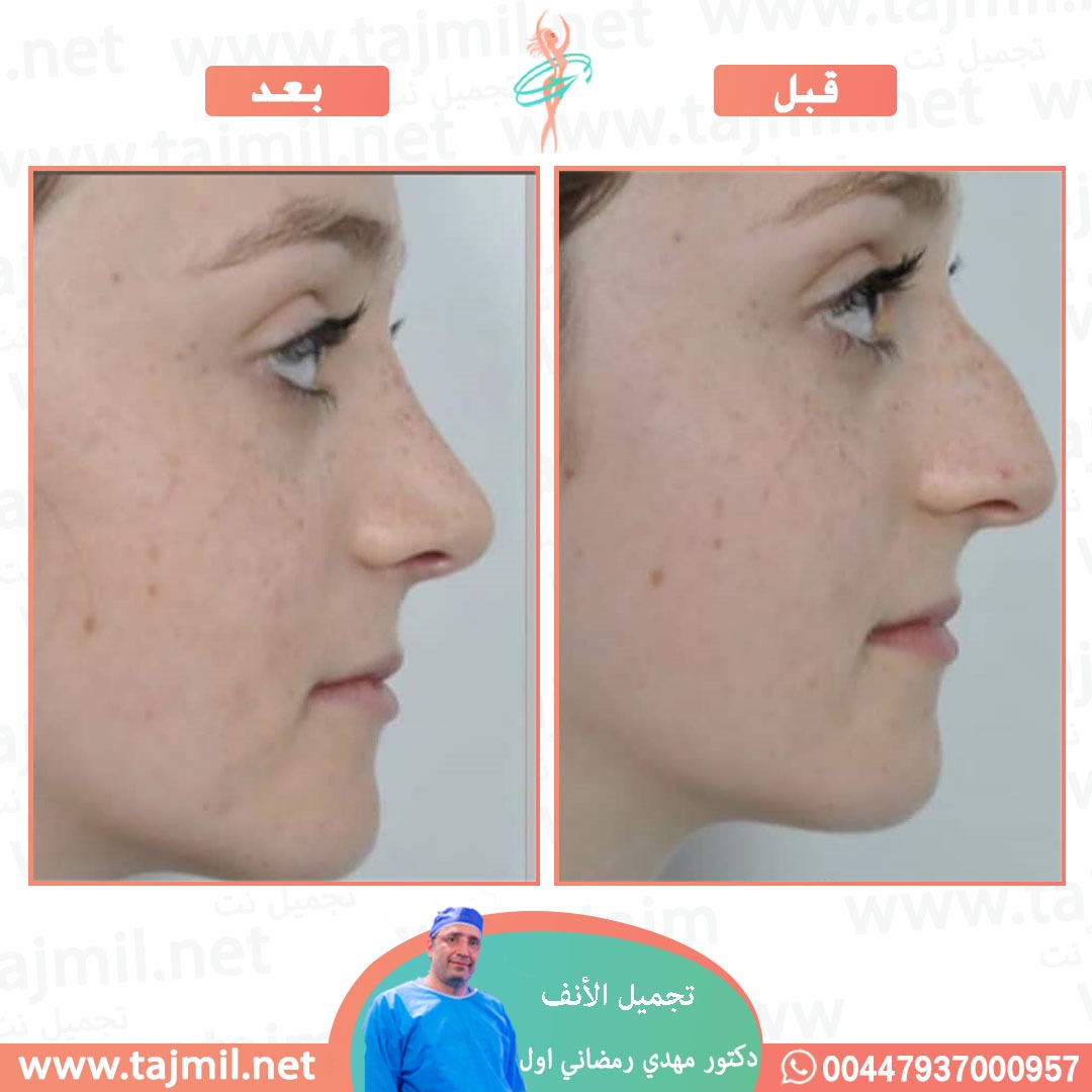  - دكتور مهدي رمضاني اول عملية تجميل الانف في ايران مع تجميل نت