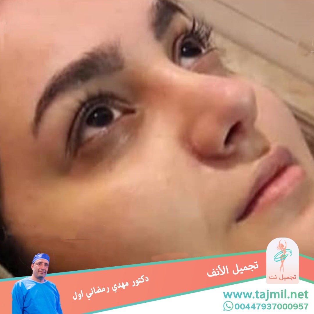  - دكتور مهدي رمضاني اول عملية تجميل الانف في ايران مع تجميل نت