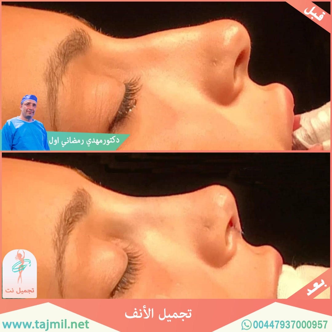  - دكتور مهدي رمضاني اول عملية تجميل الانف في ايران مع تجميل نت