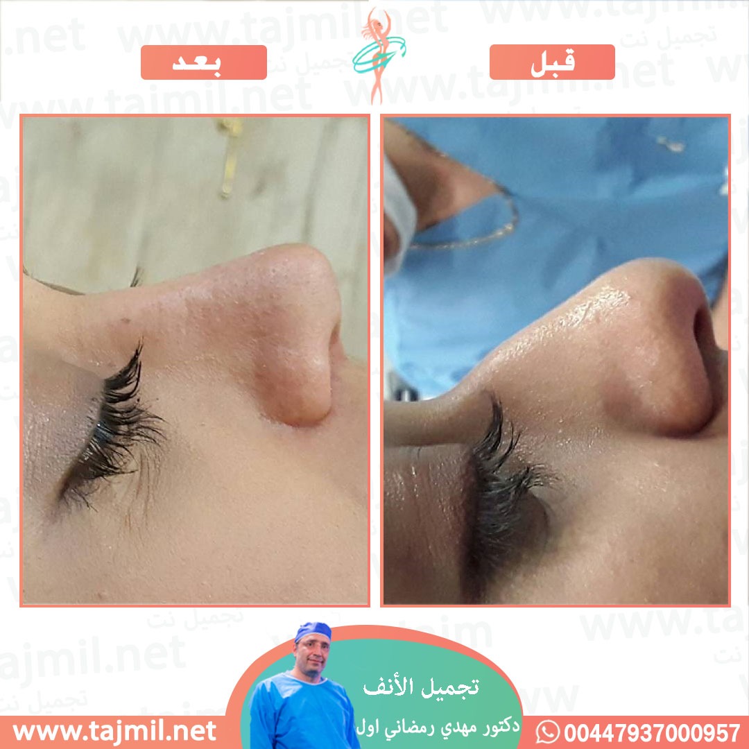  - دكتور مهدي رمضاني اول عملية تجميل الانف في ايران مع تجميل نت