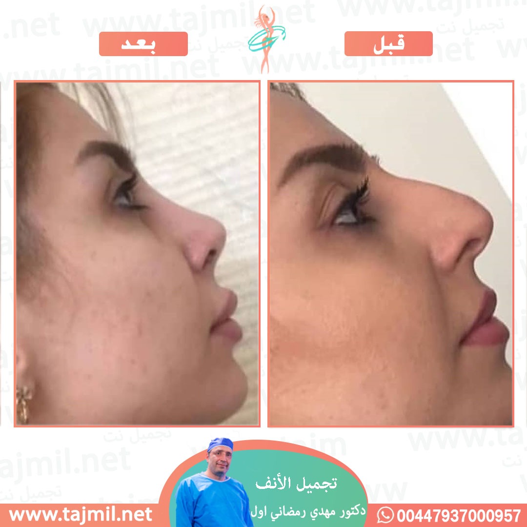  - دكتور مهدي رمضاني اول عملية تجميل الانف في ايران مع تجميل نت