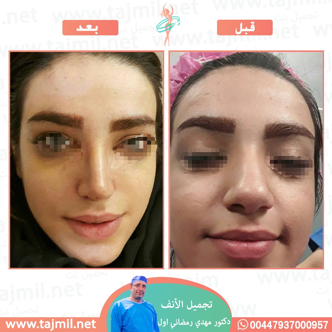  - دكتور مهدي رمضاني اول عملية تجميل الانف في ايران مع تجميل نت