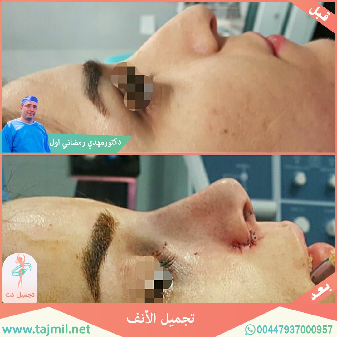  - دكتور مهدي رمضاني اول عملية تجميل الانف في ايران مع تجميل نت