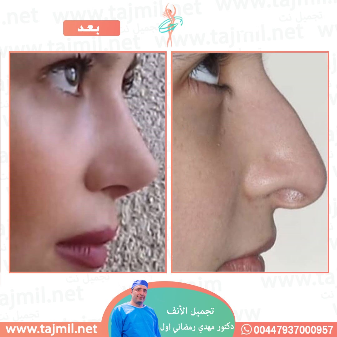  - دكتور مهدي رمضاني اول عملية تجميل الانف في ايران مع تجميل نت