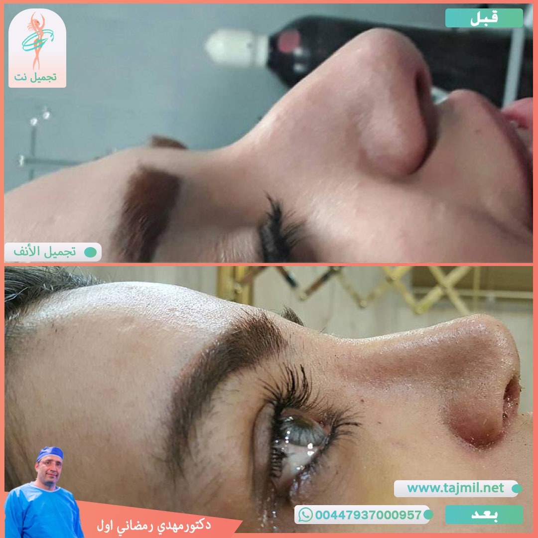  - دكتور مهدي رمضاني اول عملية تجميل الانف في ايران مع تجميل نت