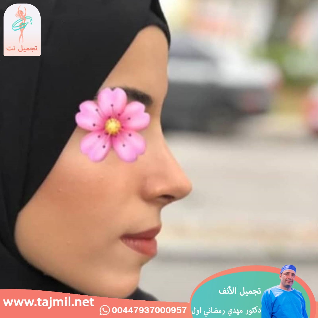  - دكتور مهدي رمضاني اول عملية تجميل الانف في ايران مع تجميل نت