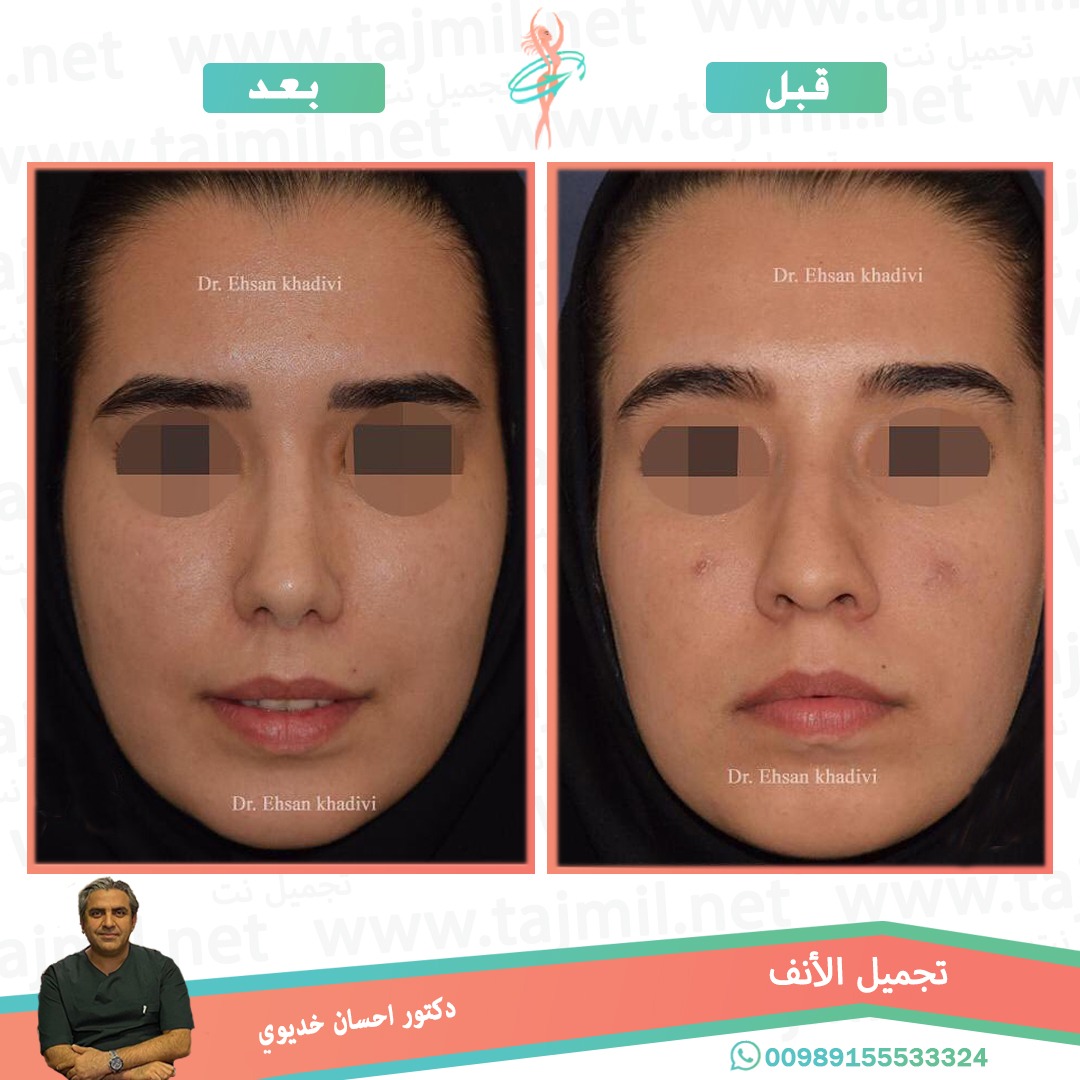  - دکتور إحسان خدیوي عملية تجميل الانف في ايران مع تجميل نت