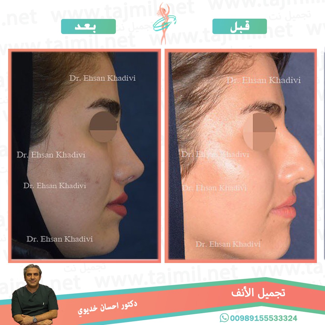  - دکتور إحسان خدیوي عملية تجميل الانف في ايران مع تجميل نت