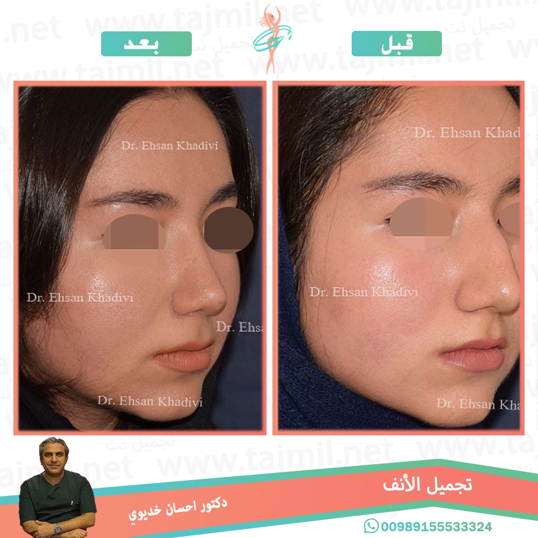  - دکتور إحسان خدیوي عملية تجميل الانف في ايران مع تجميل نت