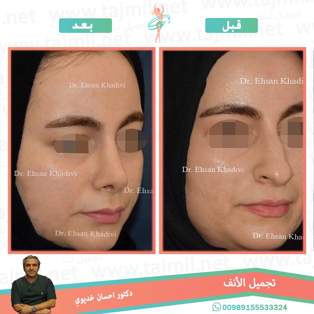  - دکتور إحسان خدیوي عملية تجميل الانف في ايران مع تجميل نت