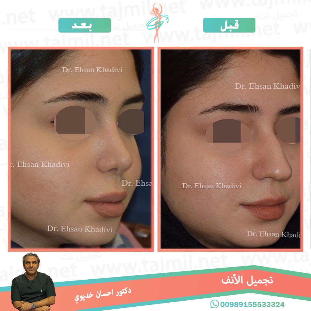  - دکتور إحسان خدیوي عملية تجميل الانف في ايران مع تجميل نت