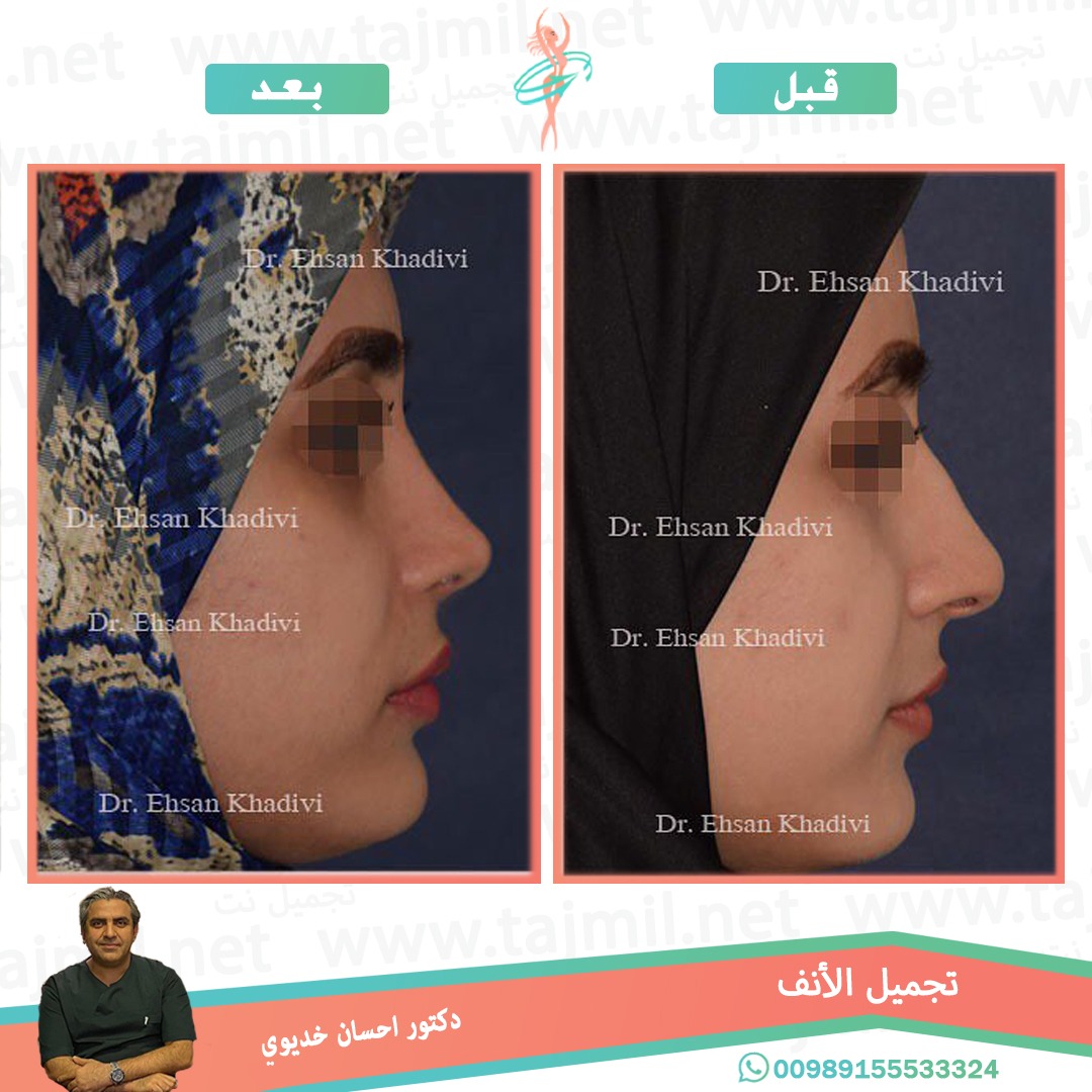  - دکتور إحسان خدیوي عملية تجميل الانف في ايران مع تجميل نت