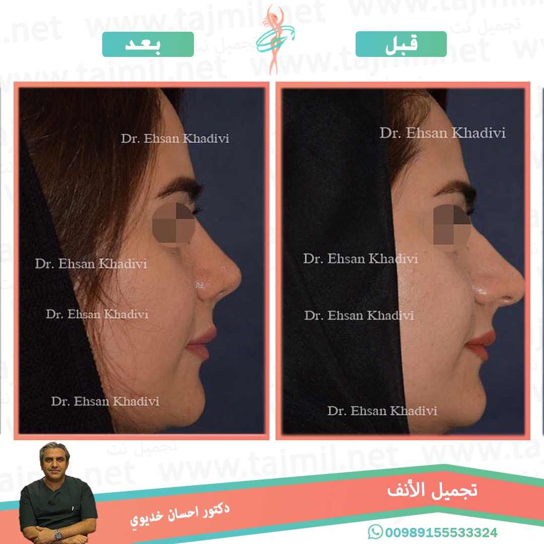  - دکتور إحسان خدیوي عملية تجميل الانف في ايران مع تجميل نت