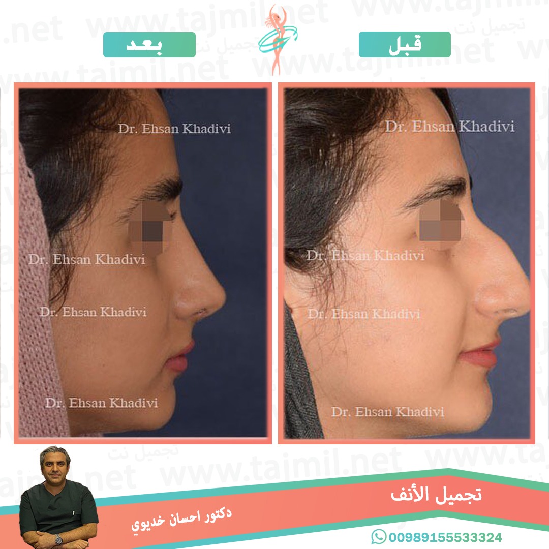  - دکتور إحسان خدیوي عملية تجميل الانف في ايران مع تجميل نت