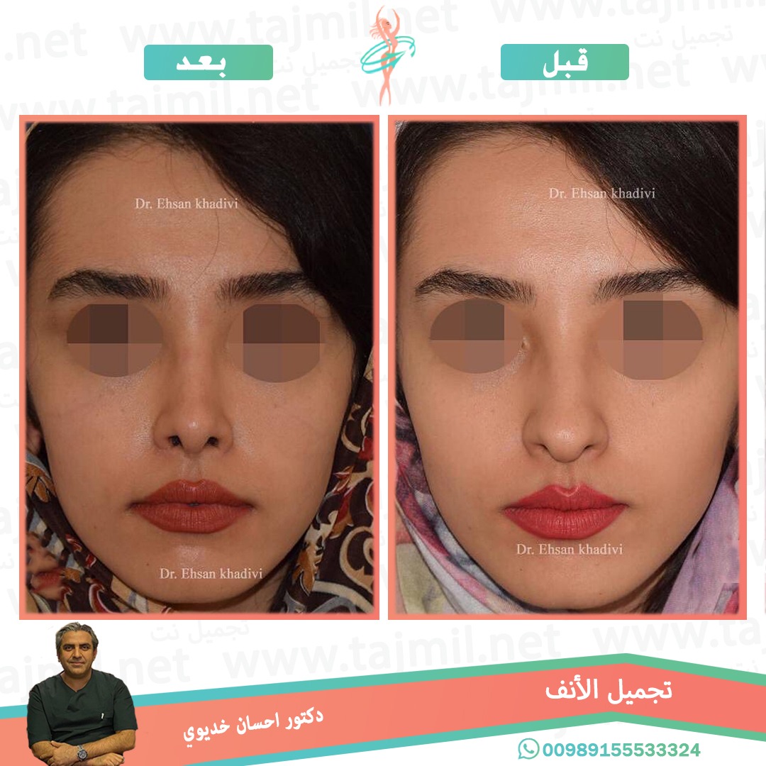  - دکتور إحسان خدیوي عملية تجميل الانف في ايران مع تجميل نت