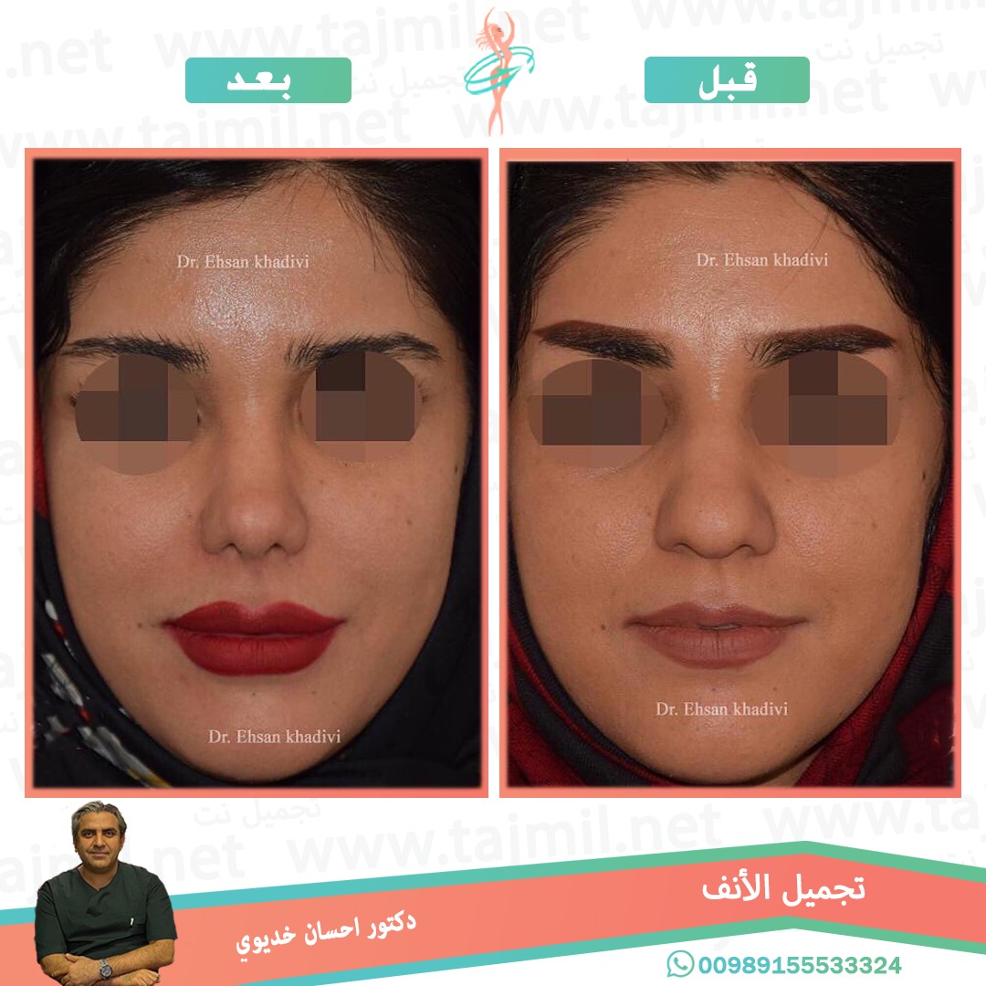  - دکتور إحسان خدیوي عملية تجميل الانف في ايران مع تجميل نت