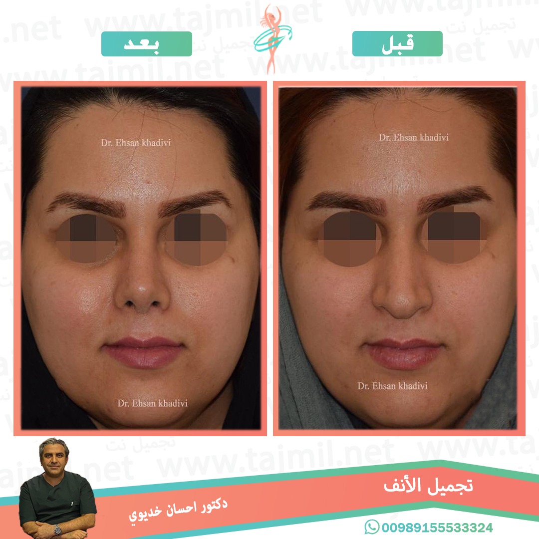  - دکتور إحسان خدیوي عملية تجميل الانف في ايران مع تجميل نت