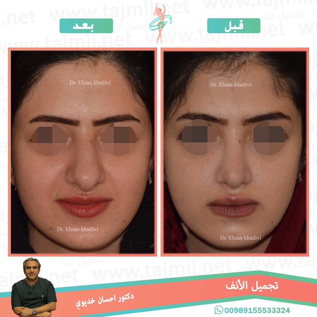  - دکتور إحسان خدیوي عملية تجميل الانف في ايران مع تجميل نت