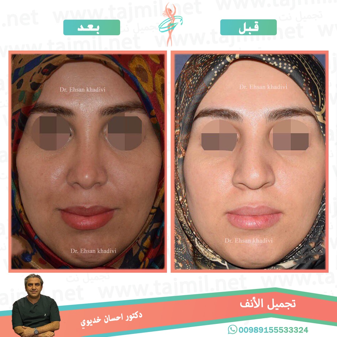  - دکتور إحسان خدیوي عملية تجميل الانف في ايران مع تجميل نت