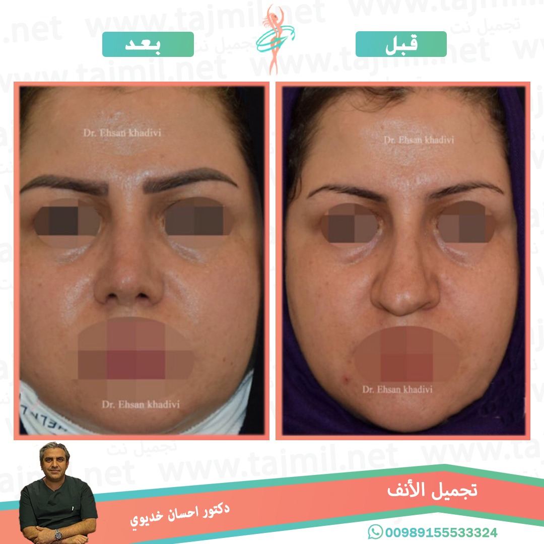  - دکتور إحسان خدیوي عملية تجميل الانف في ايران مع تجميل نت