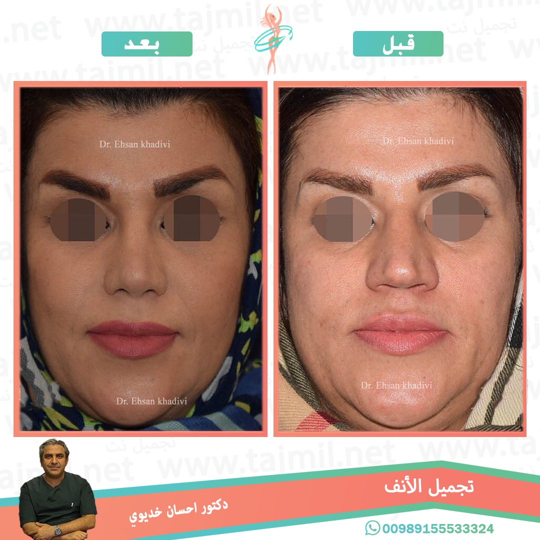  - دکتور إحسان خدیوي عملية تجميل الانف في ايران مع تجميل نت