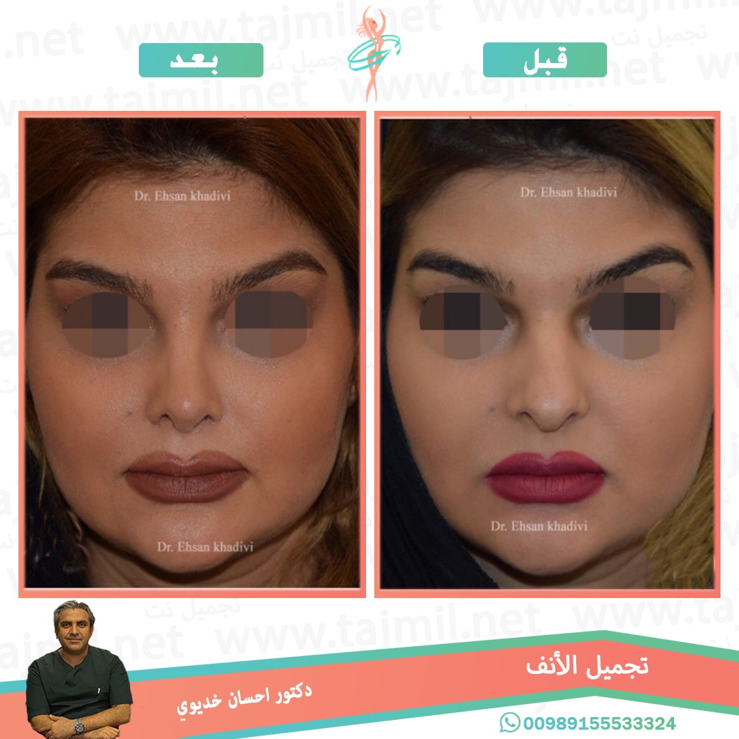  - دکتور إحسان خدیوي عملية تجميل الانف في ايران مع تجميل نت