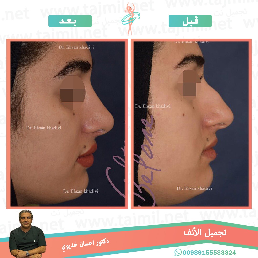  - دکتور إحسان خدیوي عملية تجميل الانف في ايران مع تجميل نت