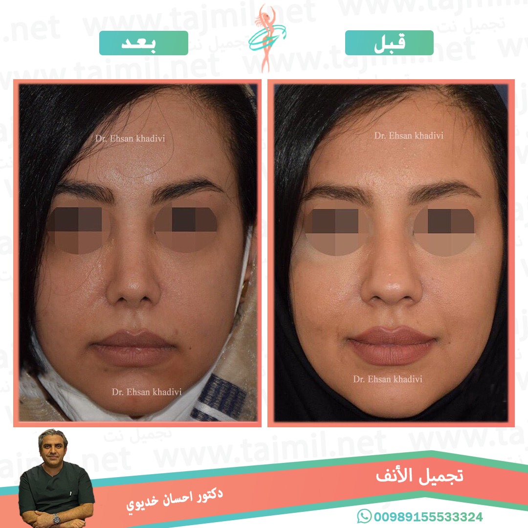  - دکتور إحسان خدیوي عملية تجميل الانف في ايران مع تجميل نت