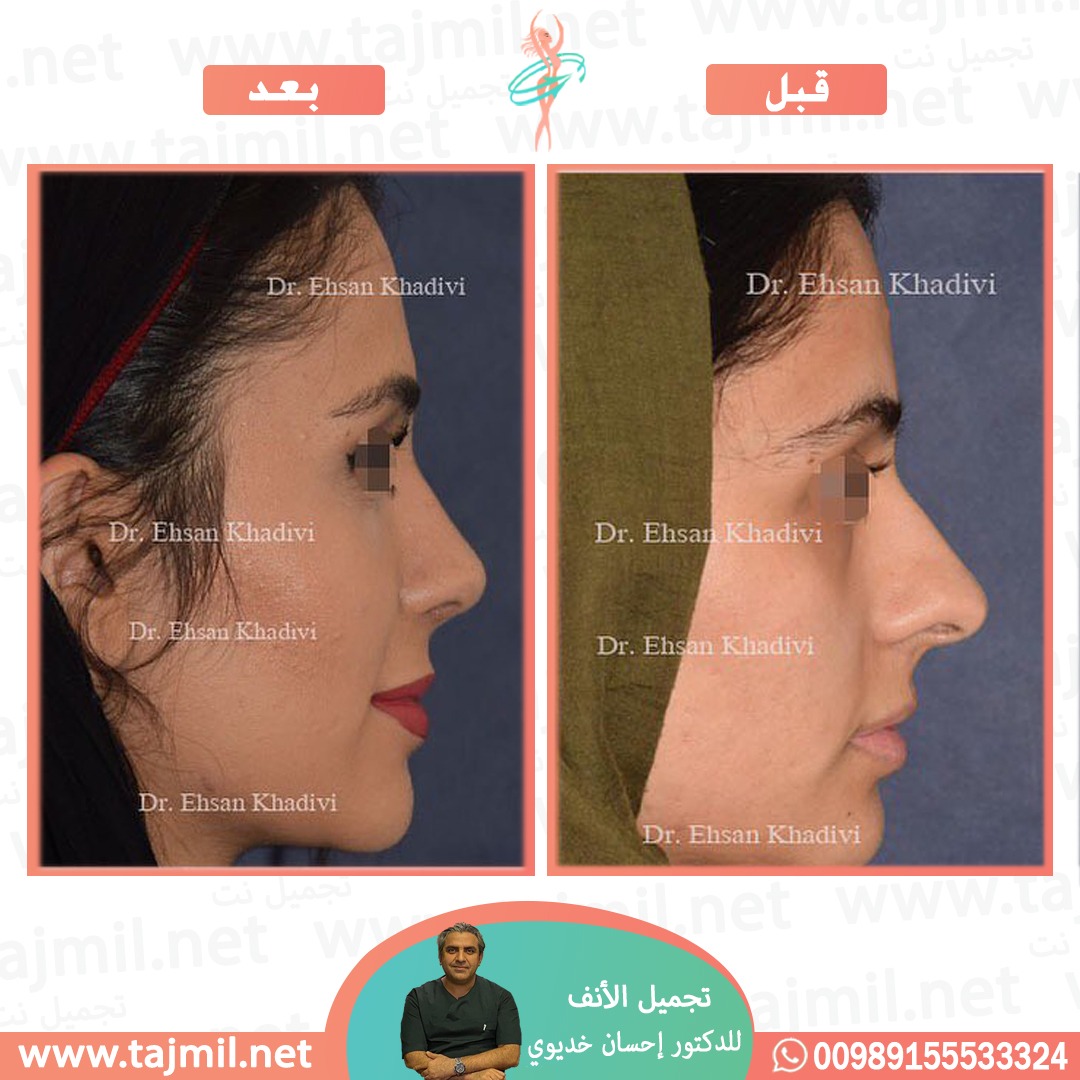  - دکتور إحسان خدیوي عملية تجميل الانف في ايران مع تجميل نت