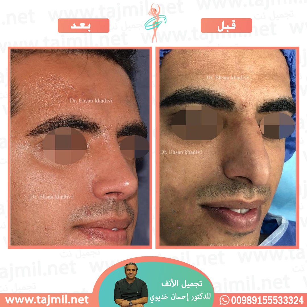  - دکتور إحسان خدیوي عملية تجميل الانف في ايران مع تجميل نت