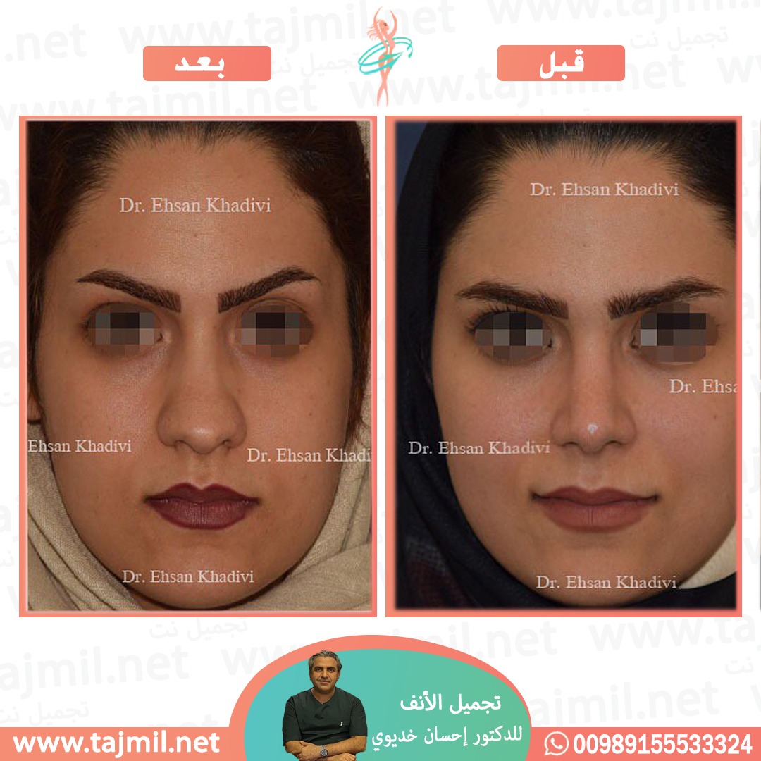  - دکتور إحسان خدیوي عملية تجميل الانف في ايران مع تجميل نت