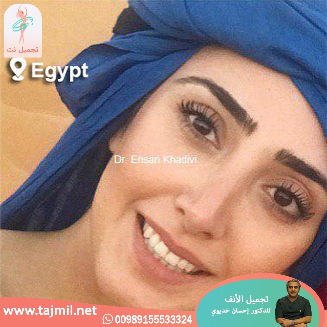  - دکتور إحسان خدیوي عملية تجميل الانف في ايران مع تجميل نت