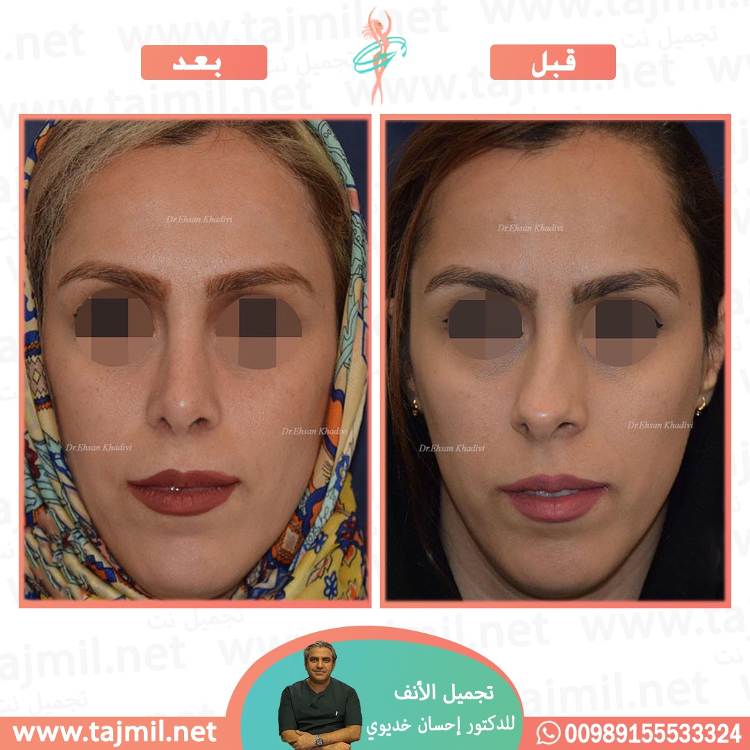  - دكتور علي أکبر صادقي عملية تجميل الانف في ايران مع تجميل نت