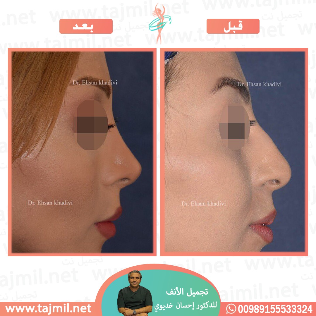  - دکتور إحسان خدیوي عملية تجميل الانف في ايران مع تجميل نت