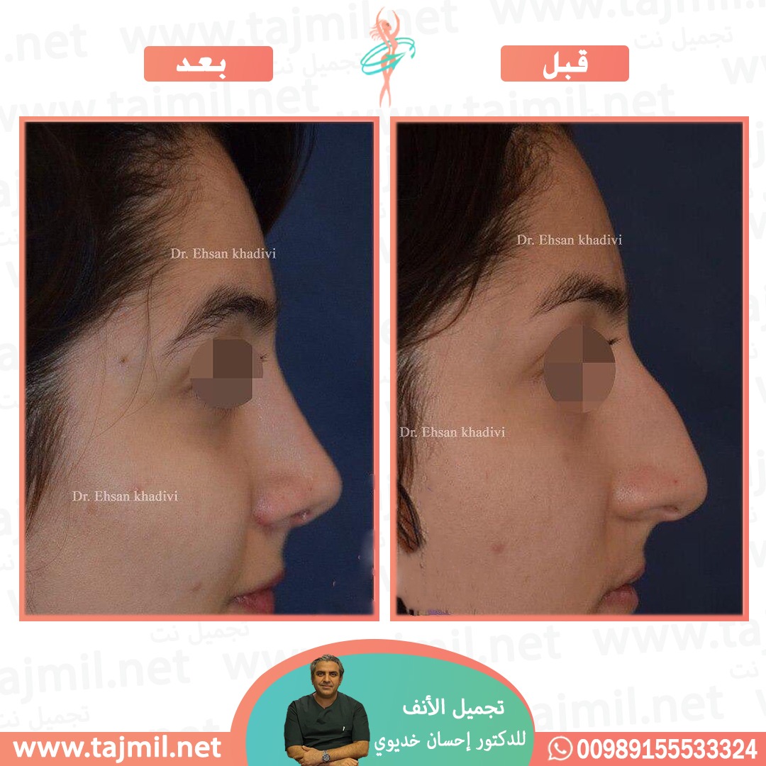  - دکتور إحسان خدیوي عملية تجميل الانف في ايران مع تجميل نت