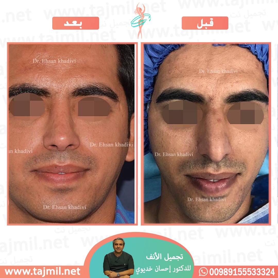  - دکتور إحسان خدیوي عملية تجميل الانف في ايران مع تجميل نت