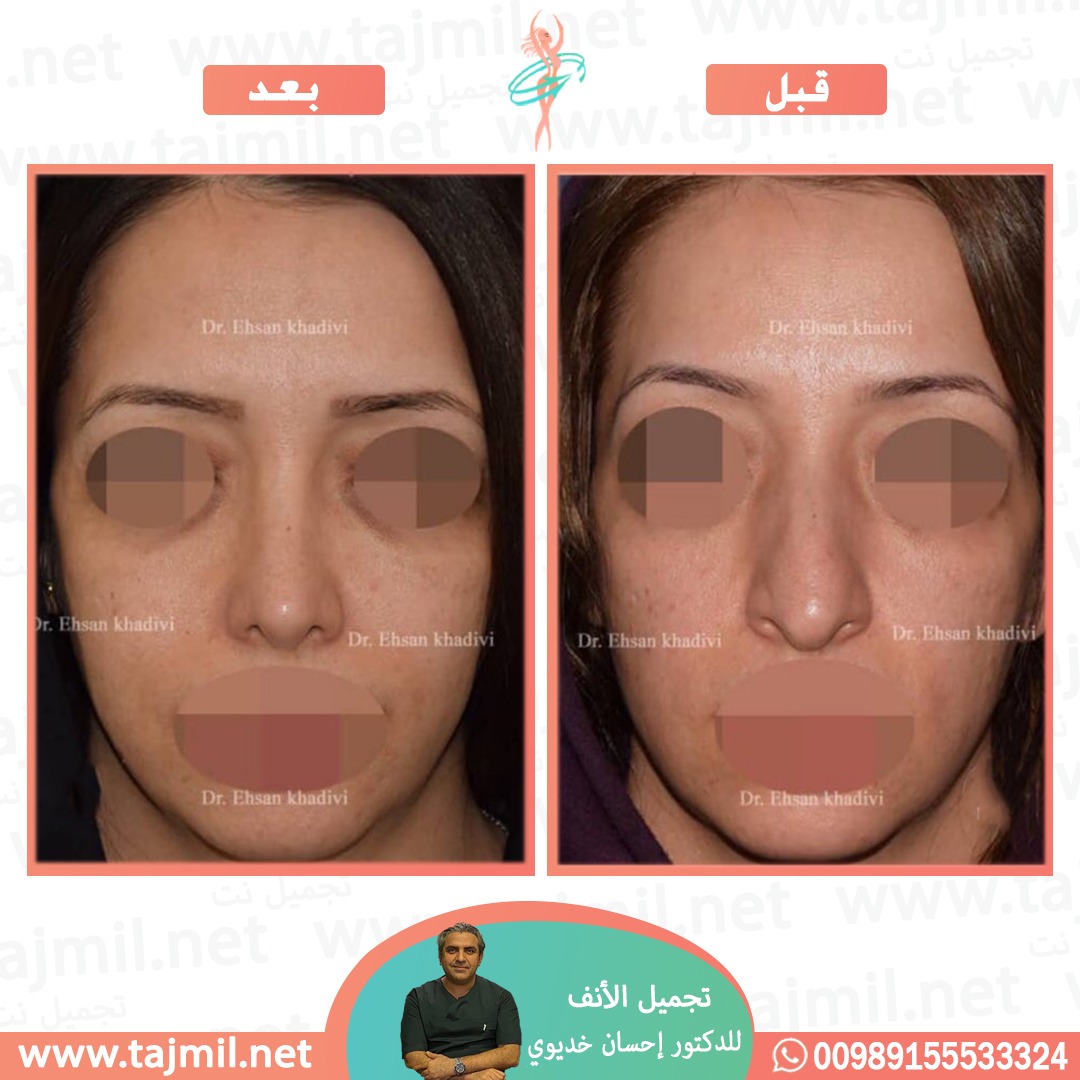  - دکتور إحسان خدیوي عملية تجميل الانف في ايران مع تجميل نت