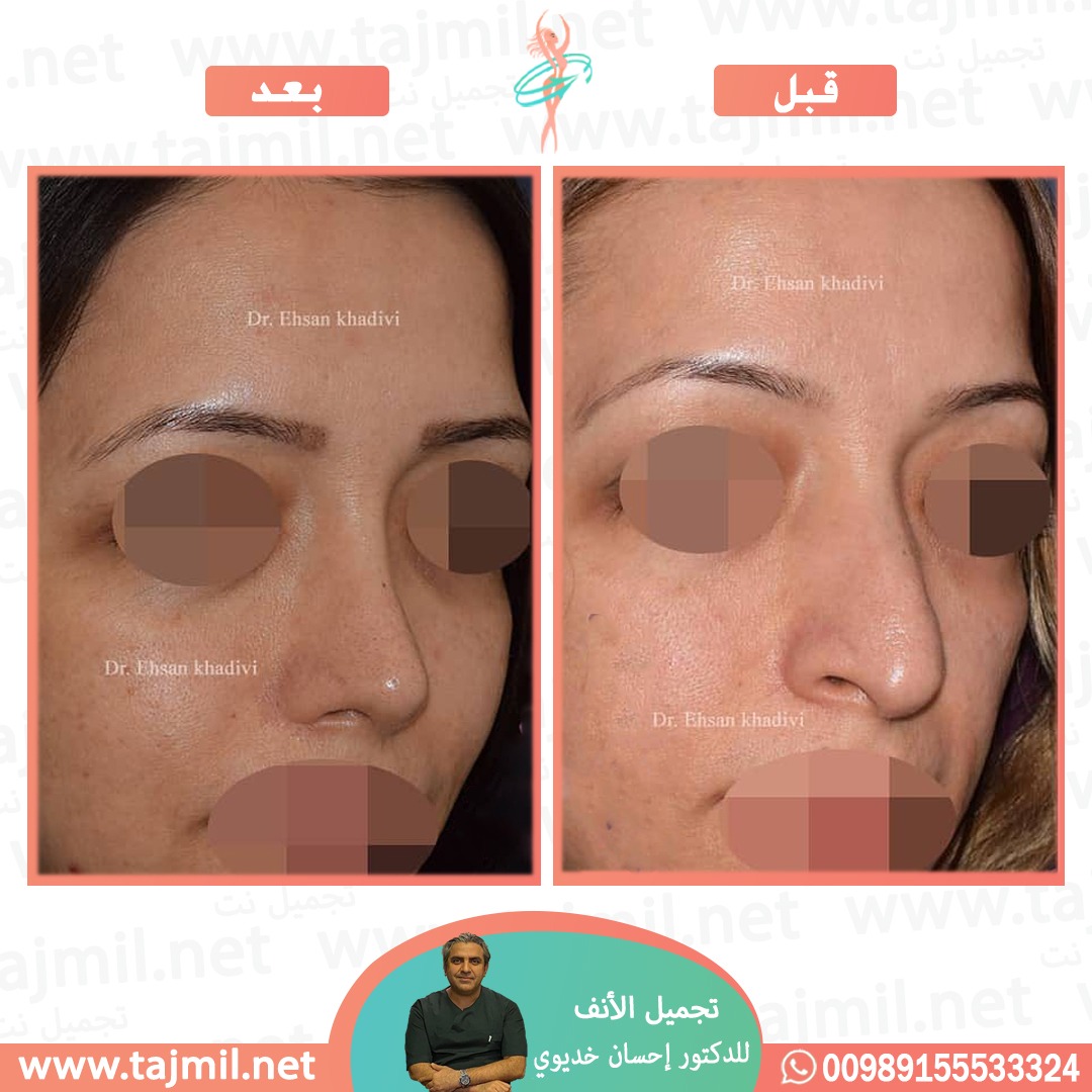  - دکتور إحسان خدیوي عملية تجميل الانف في ايران مع تجميل نت