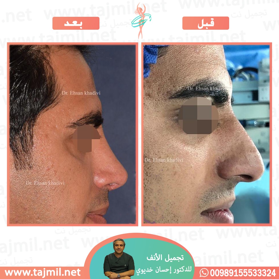  - دکتور إحسان خدیوي عملية تجميل الانف في ايران مع تجميل نت