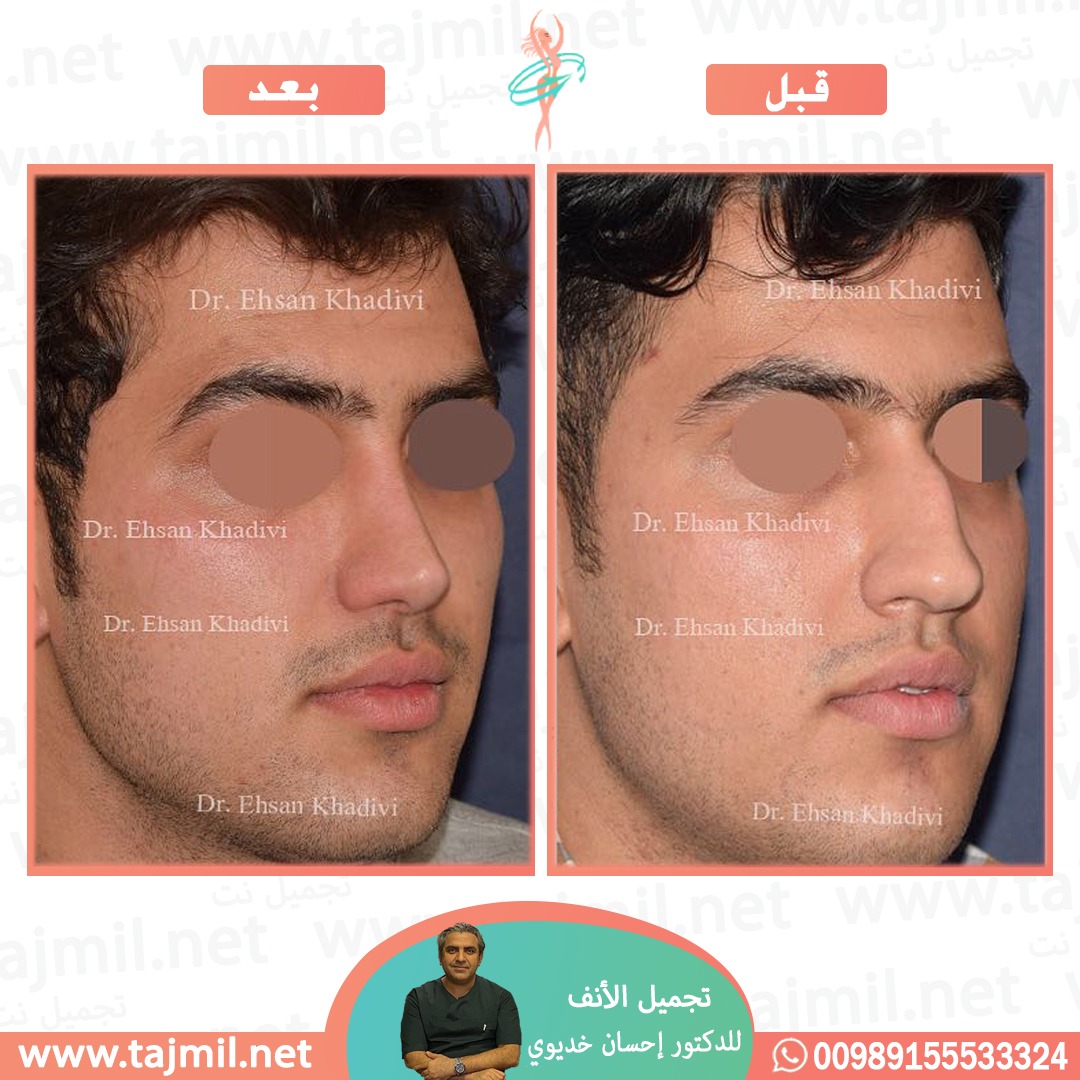  - دکتور إحسان خدیوي عملية تجميل الانف في ايران مع تجميل نت