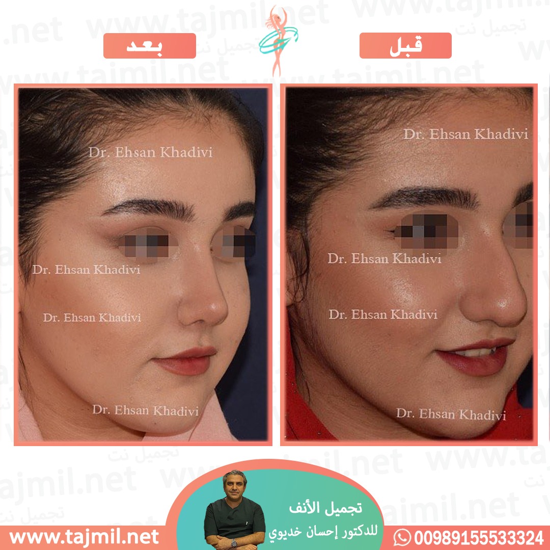  - دکتور إحسان خدیوي عملية تجميل الانف في ايران مع تجميل نت