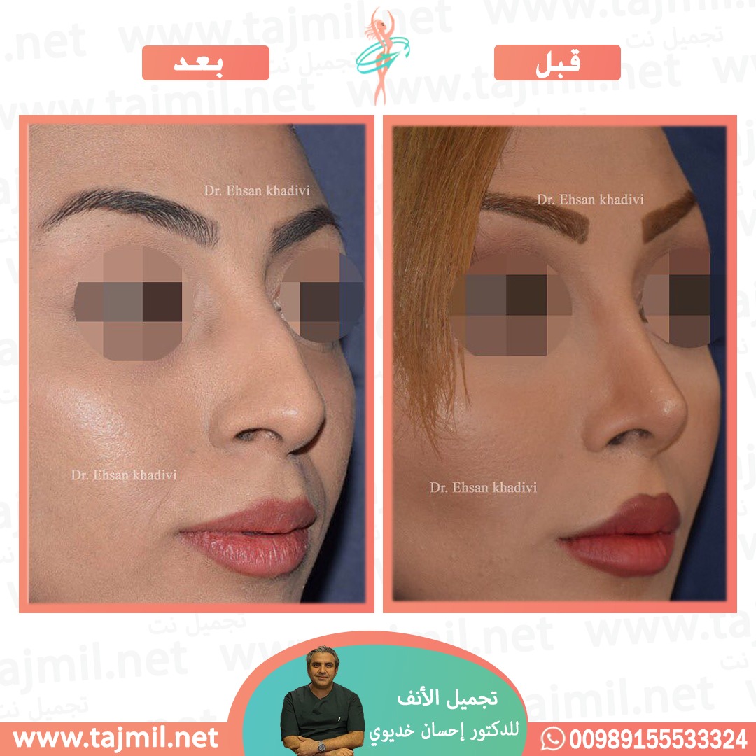  - دکتور إحسان خدیوي عملية تجميل الانف في ايران مع تجميل نت