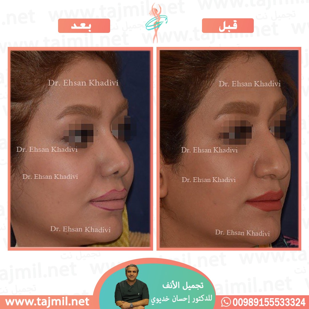  - دکتور إحسان خدیوي عملية تجميل الانف في ايران مع تجميل نت